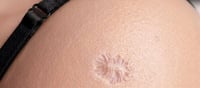 That Tiny Scar on Your Arm Isn't From a Vaccine—It's Proof Your Immune System Won a War